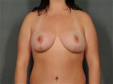 Breast Reduction After Photo by Ellen Janetzke, MD; Bloomfield Hills, MI - Case 28760