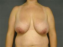 Breast Reduction Before Photo by Ellen Janetzke, MD; Bloomfield Hills, MI - Case 28760