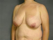 Breast Reduction Before Photo by Ellen Janetzke, MD; Bloomfield Hills, MI - Case 28760