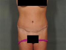 Tummy Tuck After Photo by Ellen Janetzke, MD; Bloomfield Hills, MI - Case 28761