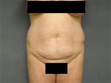 Tummy Tuck Before Photo by Ellen Janetzke, MD; Bloomfield Hills, MI - Case 28761