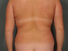 Liposuction After Photo by Ellen Janetzke, MD; Bloomfield Hills, MI - Case 28762