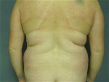 Liposuction Before Photo by Ellen Janetzke, MD; Bloomfield Hills, MI - Case 28762