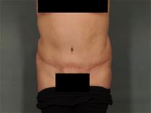 Tummy Tuck After Photo by Ellen Janetzke, MD; Bloomfield Hills, MI - Case 28771