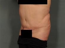 Tummy Tuck After Photo by Ellen Janetzke, MD; Bloomfield Hills, MI - Case 28771