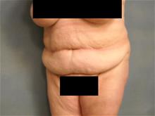 Tummy Tuck Before Photo by Ellen Janetzke, MD; Bloomfield Hills, MI - Case 28771