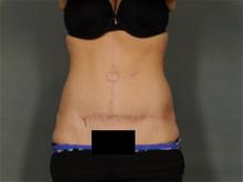 Tummy Tuck After Photo by Ellen Janetzke, MD; Bloomfield Hills, MI - Case 28954