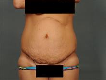 Tummy Tuck Before Photo by Ellen Janetzke, MD; Bloomfield Hills, MI - Case 28954