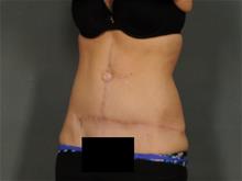 Tummy Tuck After Photo by Ellen Janetzke, MD; Bloomfield Hills, MI - Case 28954