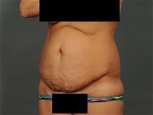 Tummy Tuck Before Photo by Ellen Janetzke, MD; Bloomfield Hills, MI - Case 28954