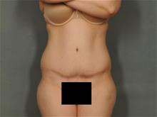 Tummy Tuck After Photo by Ellen Janetzke, MD; Bloomfield Hills, MI - Case 28955