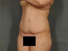 Tummy Tuck After Photo by Ellen Janetzke, MD; Bloomfield Hills, MI - Case 28955