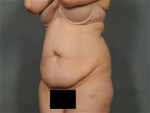 Tummy Tuck Before Photo by Ellen Janetzke, MD; Bloomfield Hills, MI - Case 28955
