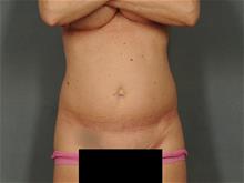 Tummy Tuck Before Photo by Ellen Janetzke, MD; Bloomfield Hills, MI - Case 28975