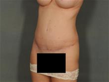 Tummy Tuck After Photo by Ellen Janetzke, MD; Bloomfield Hills, MI - Case 28975