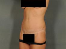 Tummy Tuck After Photo by Ellen Janetzke, MD; Bloomfield Hills, MI - Case 28982