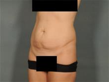 Tummy Tuck Before Photo by Ellen Janetzke, MD; Bloomfield Hills, MI - Case 28982