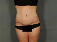 Tummy Tuck After Photo by Ellen Janetzke, MD; Bloomfield Hills, MI - Case 29028