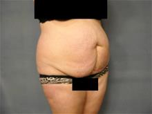 Tummy Tuck Before Photo by Ellen Janetzke, MD; Bloomfield Hills, MI - Case 29028