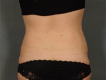 Liposuction After Photo by Ellen Janetzke, MD; Bloomfield Hills, MI - Case 29029