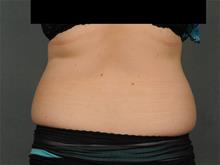 Liposuction Before Photo by Ellen Janetzke, MD; Bloomfield Hills, MI - Case 29029