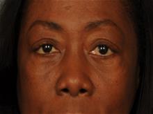 Eyelid Surgery After Photo by Ellen Janetzke, MD; Bloomfield Hills, MI - Case 29030
