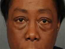 Eyelid Surgery Before Photo by Ellen Janetzke, MD; Bloomfield Hills, MI - Case 29030