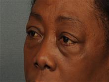 Eyelid Surgery Before Photo by Ellen Janetzke, MD; Bloomfield Hills, MI - Case 29030