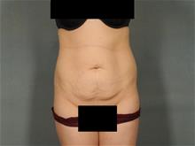 Tummy Tuck Before Photo by Ellen Janetzke, MD; Bloomfield Hills, MI - Case 29031