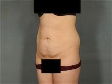 Tummy Tuck Before Photo by Ellen Janetzke, MD; Bloomfield Hills, MI - Case 29031