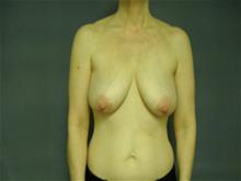 Breast Lift Before Photo by Ellen Janetzke, MD; Bloomfield Hills, MI - Case 29034