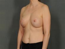 Breast Lift After Photo by Ellen Janetzke, MD; Bloomfield Hills, MI - Case 29034