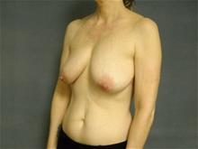 Breast Lift Before Photo by Ellen Janetzke, MD; Bloomfield Hills, MI - Case 29034