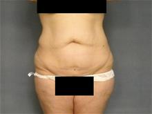 Tummy Tuck Before Photo by Ellen Janetzke, MD; Bloomfield Hills, MI - Case 29035