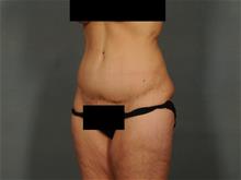 Tummy Tuck After Photo by Ellen Janetzke, MD; Bloomfield Hills, MI - Case 29035