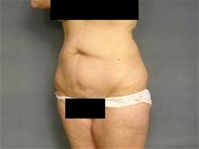 Tummy Tuck Before Photo by Ellen Janetzke, MD; Bloomfield Hills, MI - Case 29035