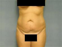 Tummy Tuck Before Photo by Ellen Janetzke, MD; Bloomfield Hills, MI - Case 29036
