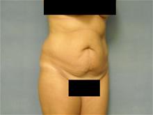 Tummy Tuck Before Photo by Ellen Janetzke, MD; Bloomfield Hills, MI - Case 29036