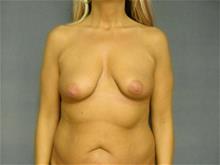 Breast Augmentation Before Photo by Ellen Janetzke, MD; Bloomfield Hills, MI - Case 29037
