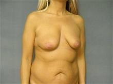 Breast Augmentation Before Photo by Ellen Janetzke, MD; Bloomfield Hills, MI - Case 29037