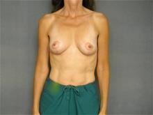 Breast Lift After Photo by Ellen Janetzke, MD; Bloomfield Hills, MI - Case 29050