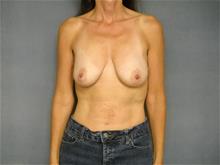 Breast Lift Before Photo by Ellen Janetzke, MD; Bloomfield Hills, MI - Case 29050