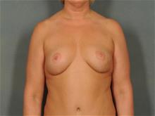 Breast Lift After Photo by Ellen Janetzke, MD; Bloomfield Hills, MI - Case 29051