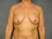 Breast Lift Before Photo by Ellen Janetzke, MD; Bloomfield Hills, MI - Case 29051