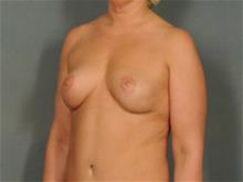 Breast Lift After Photo by Ellen Janetzke, MD; Bloomfield Hills, MI - Case 29051
