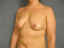 Breast Lift Before Photo by Ellen Janetzke, MD; Bloomfield Hills, MI - Case 29051
