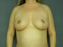 Breast Lift After Photo by Ellen Janetzke, MD; Bloomfield Hills, MI - Case 29052