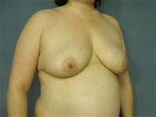 Breast Lift Before Photo by Ellen Janetzke, MD; Bloomfield Hills, MI - Case 29052