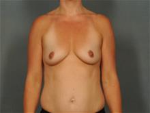 Breast Augmentation Before Photo by Ellen Janetzke, MD; Bloomfield Hills, MI - Case 29103