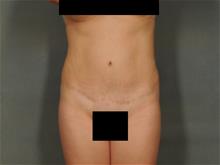 Tummy Tuck After Photo by Ellen Janetzke, MD; Bloomfield Hills, MI - Case 29104